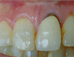 歯周病治療は新宿区新宿の歯医者松田歯科医院セルコンスマートセラミックス治療前