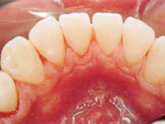 歯周病治療は新宿区新宿の歯医者松田歯科医院デンタルクリーニング