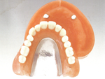 歯周病治療は新宿区新宿の歯医者松田歯科医院磁性アッチメント